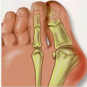 1Pair=2Pcs Bunion Protector Feet Care Orthotics Pedicure Tool Hallux Valgus Corrector Orthopedic Adjuster Bunion Foot Massager